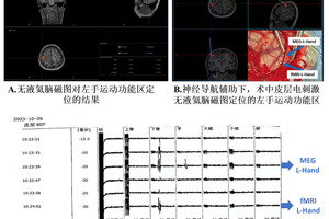 全球首例无液氦脑磁图辅助下的胶质瘤切除手术顺利完成